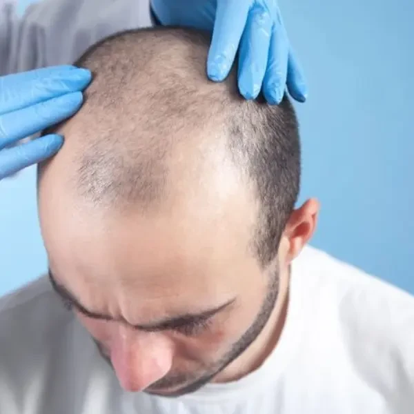 the Best Hair Transplant Centers in Egypt
