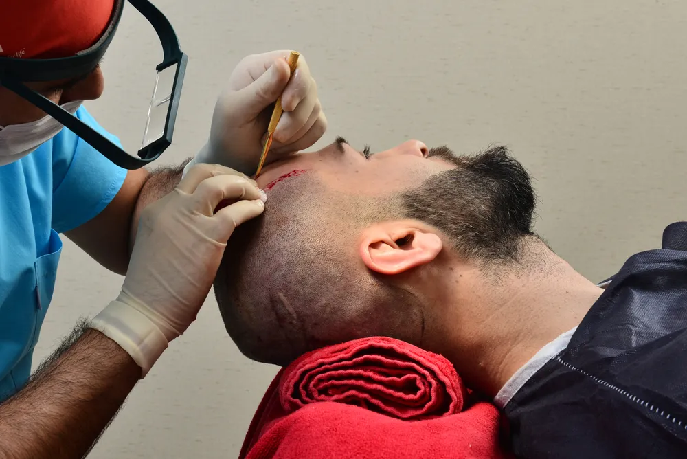 مين جرب زراعة الشعر في مصر