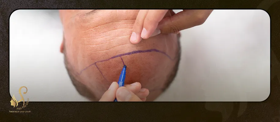 Types of hair transplants