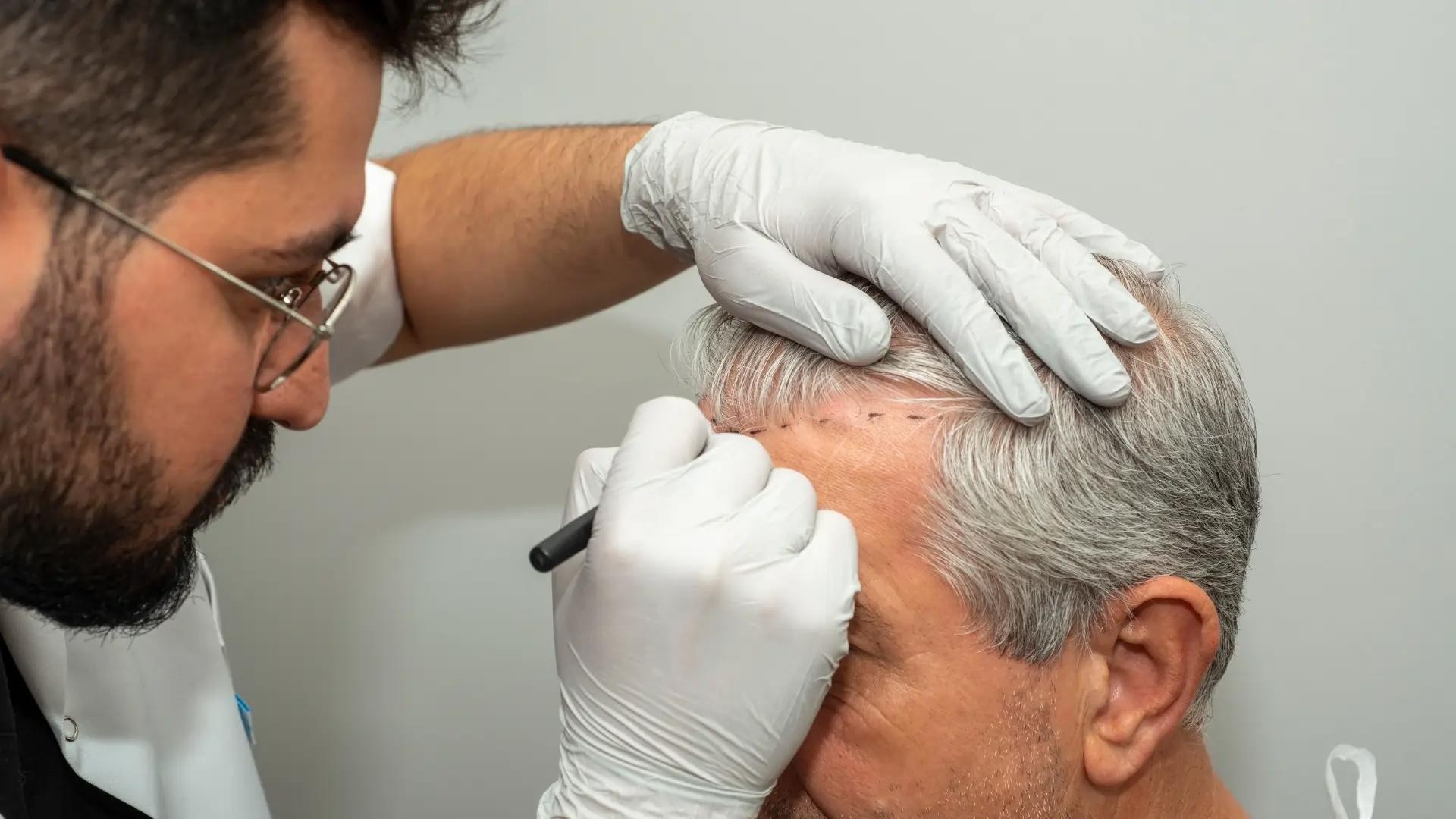 The best hair transplant places in Egypt