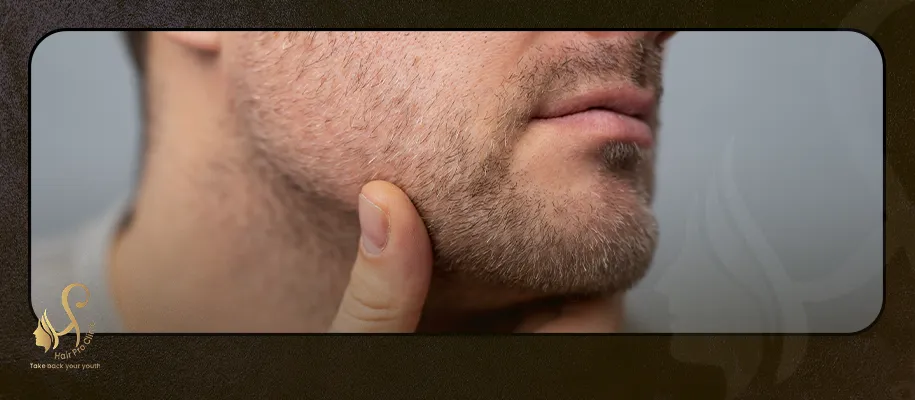 تكلفة عملية زراعة شعر الذقن فى مصر