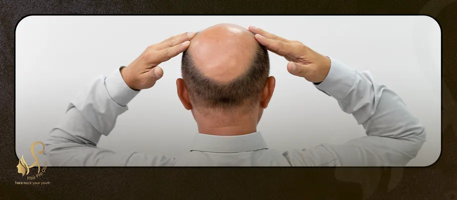 Hair transplant cost in Egypt