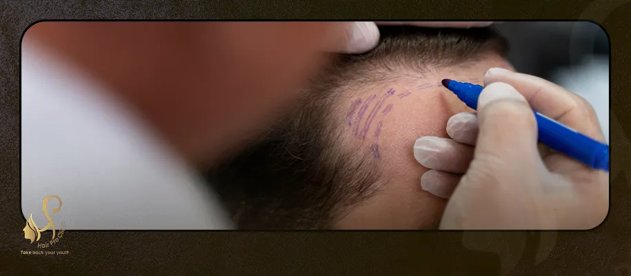 The latest methods of treatment for hereditary baldness