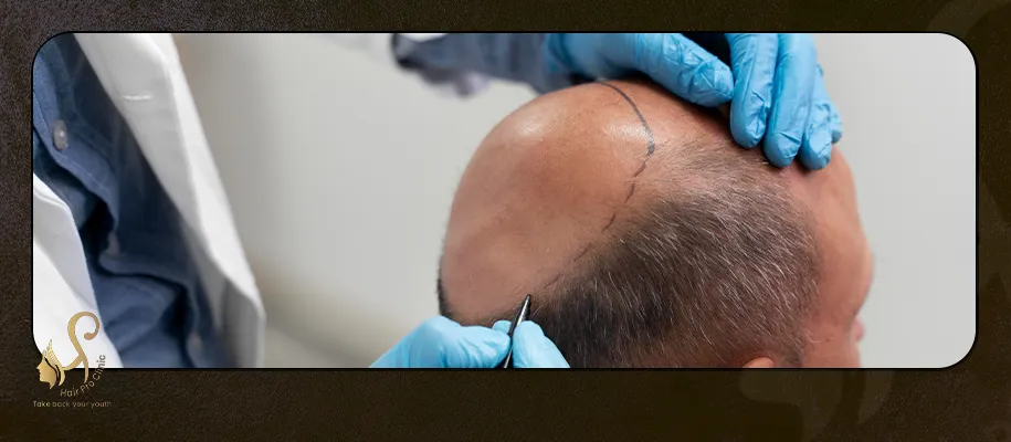 زراعة الشعر من اللحية لفروة الرأس