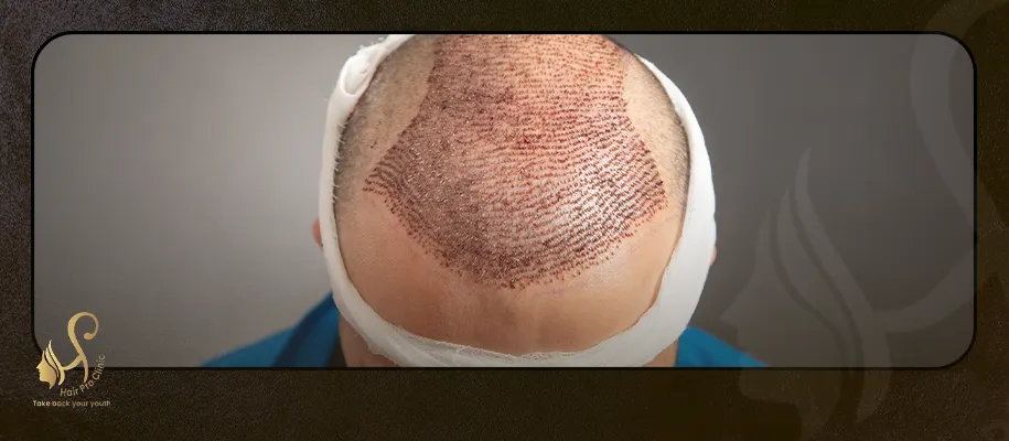 Types of exosomes for hair