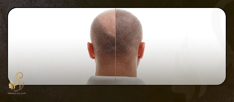 Stages of hair growth after transplantation with pictures