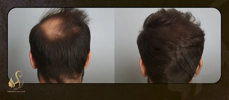 Mesotherapy Hair Session Price