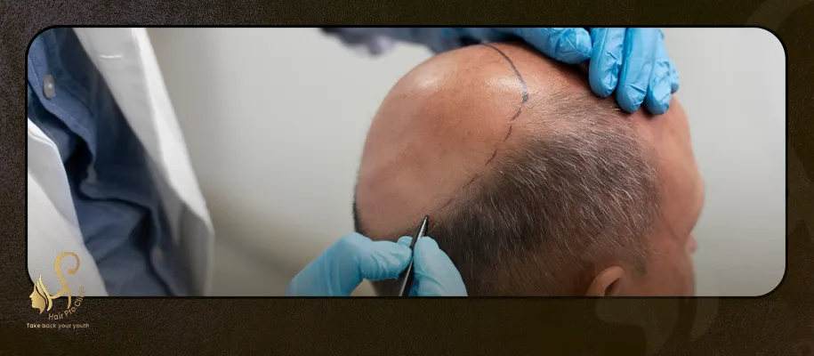 Top hair transplant surgeon in Egypt