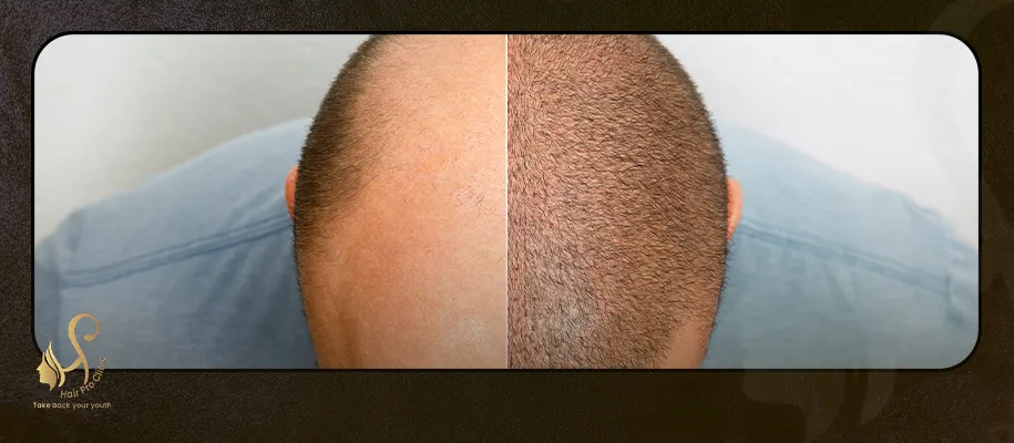 Exosome Hair Needle Price in Egypt