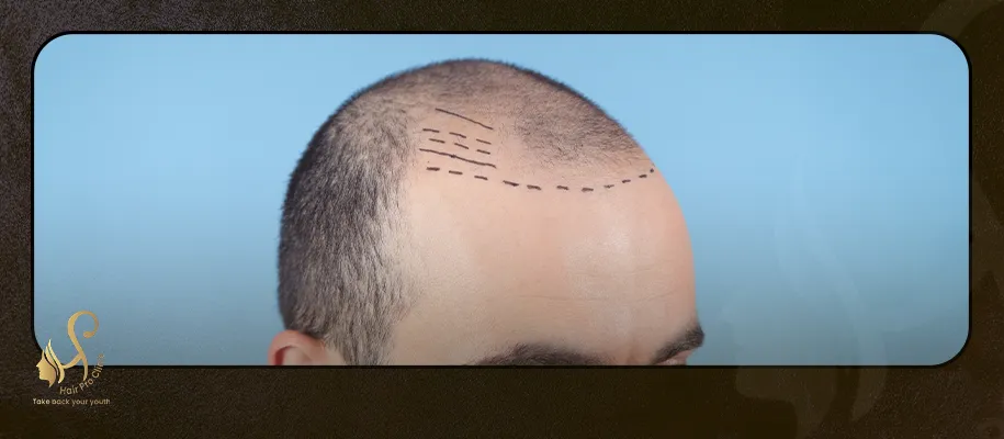 زراعة الشعر في مصر للرجال