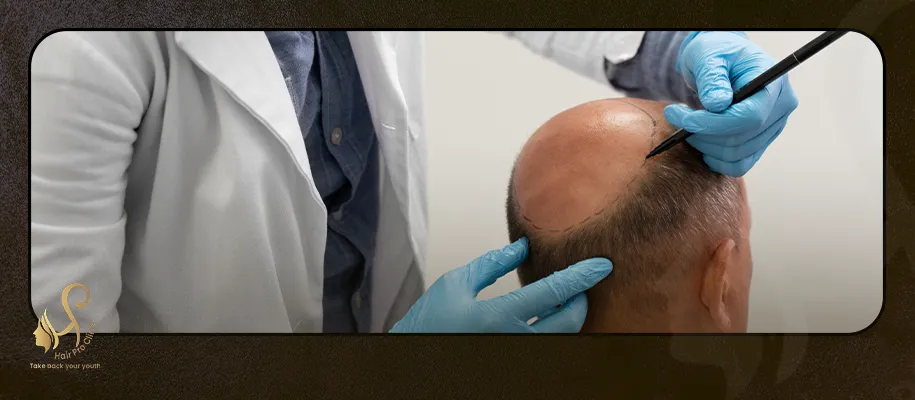 the Best Hair Transplant Centers in Egypt