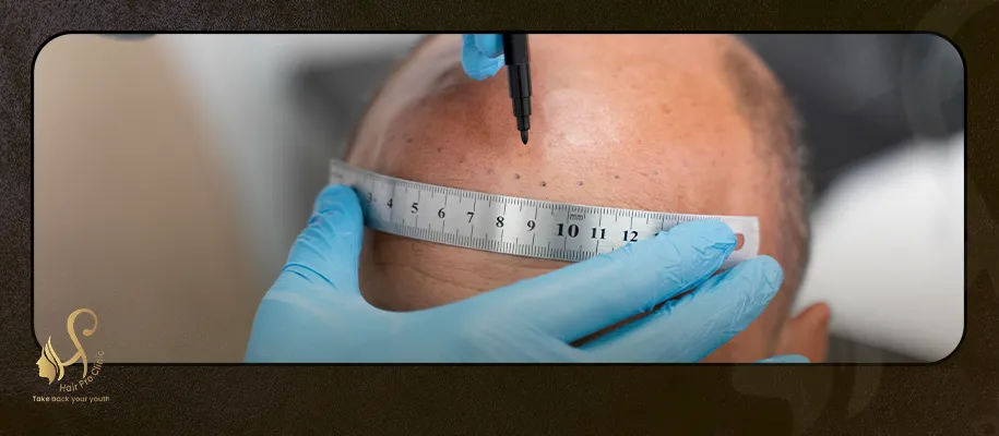 Hair Transplant Cost for Men in Egypt