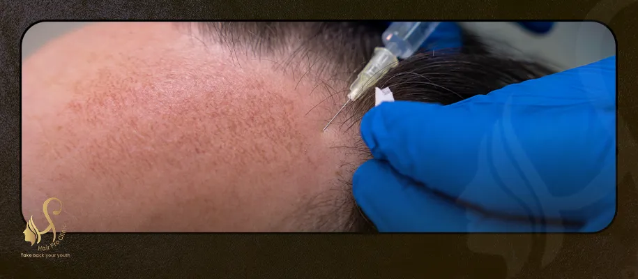 Best Hair Transplant Doctors in Egypt