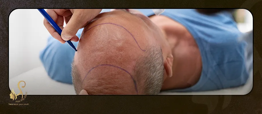 Who tried hair transplantation in Egypt