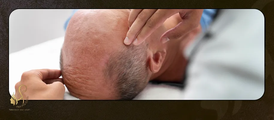 زراعة الشعر فى اماكن الجروح