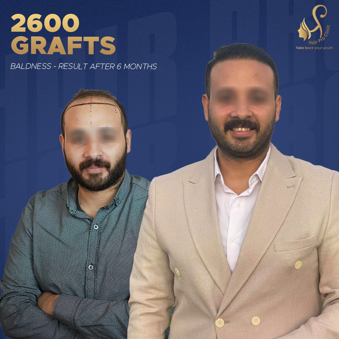 زراعة الشعر