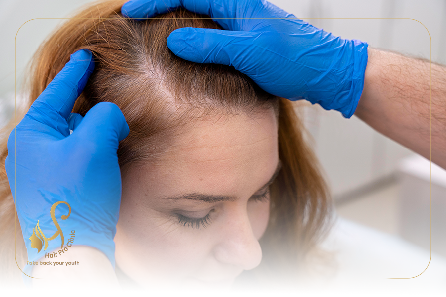 Female Hair transplant