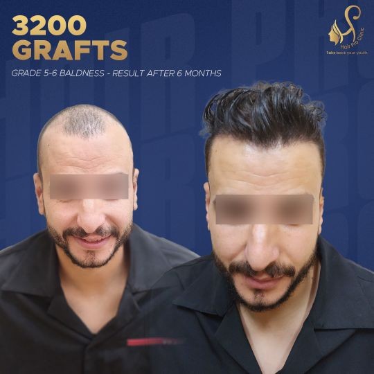 زراعة الشعر