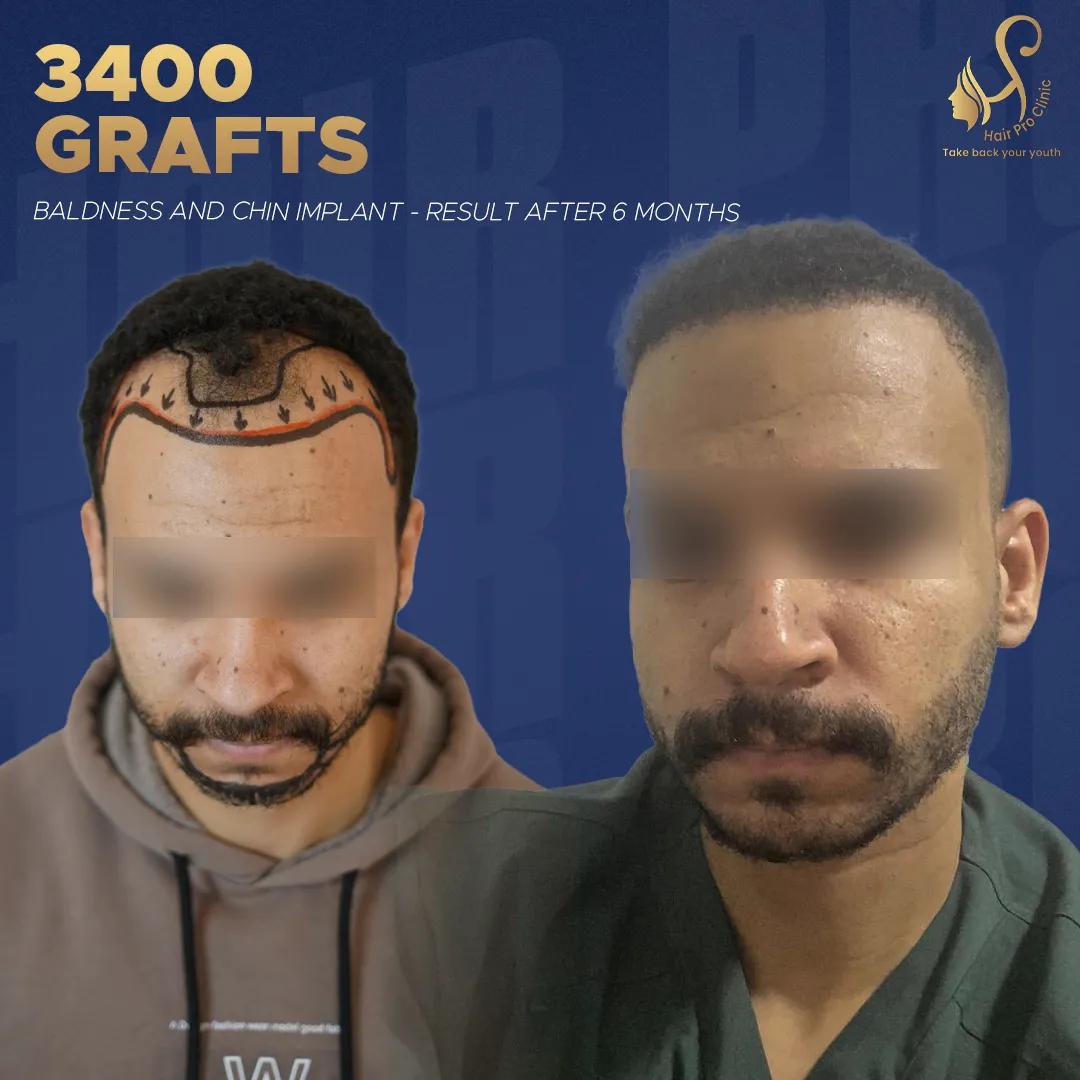 Hair Transplant