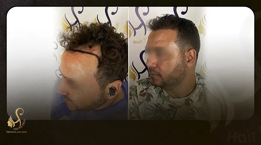 زراعة الشعر