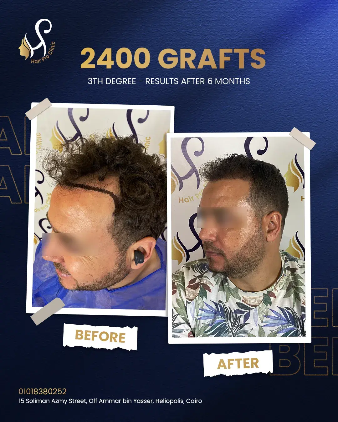 اسعار عملية زراعة الشعر فى مصر