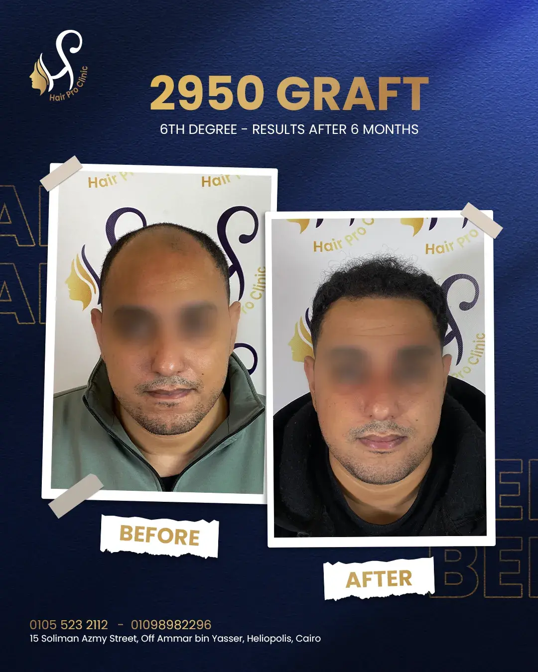 كم تكلف زراعة الشعر في مصر