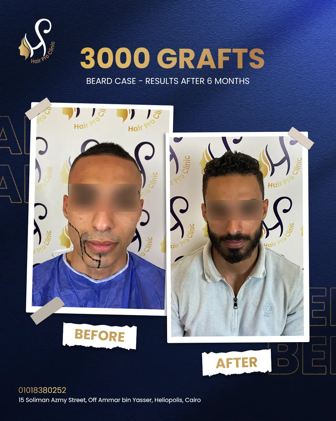 اسعار عملية زراعة الشعر فى مصر